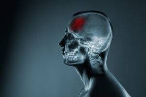 What Costs Are Associated With Hiring a Brain Injury Lawyer?