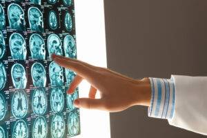 Can I File a Lawsuit if My Loved One Suffered a Fatal Brain Injury?